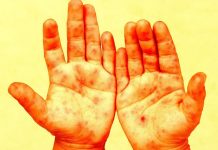 The CDC Is Now Denying That Specific Children Died From Measles, in a Scandal Potentially Beyond Anything in Its History